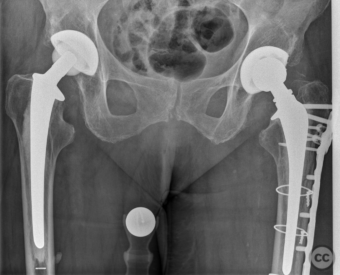 Vancouver B Periprosthetic Femur Fracture Lcp Broard Curved